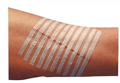 Steri-strip u uporabi Steri-strip u uporabi